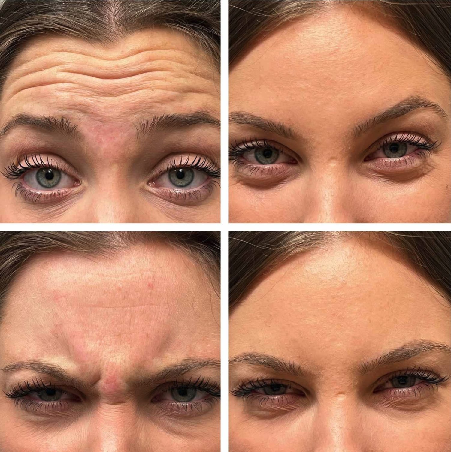 Forehead and frown lines, before and after at Skin&Co Mississauga