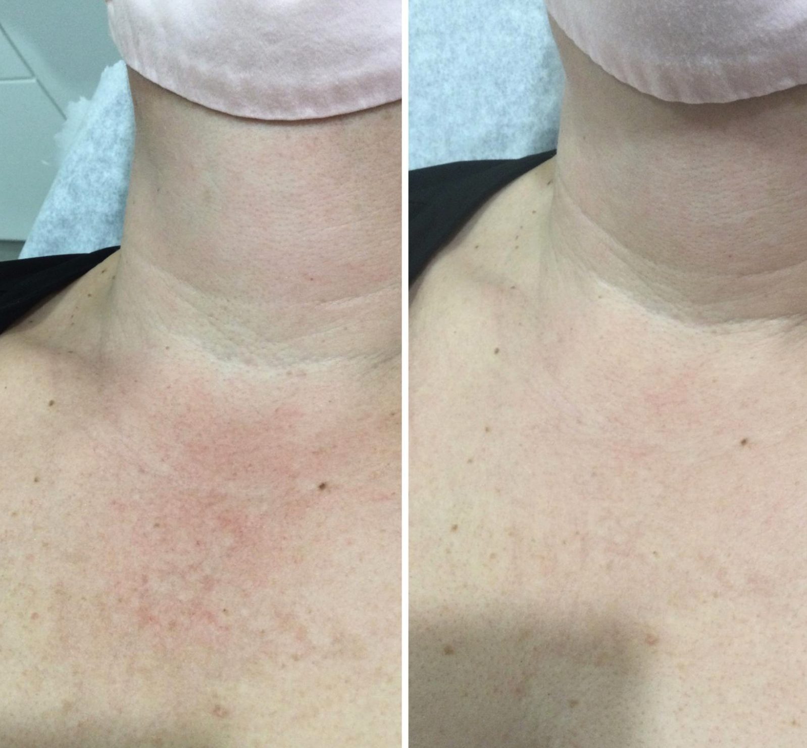 Tone across the neck and chest, before and after at Skin&Co Mississauga