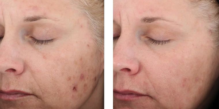Pigmented spots across the face, before and after at Skin&Co Mississauga